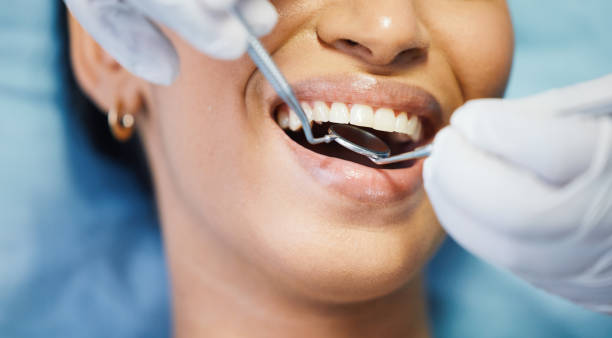 Best Emergency Tooth Extraction in Ville Ptte, LA