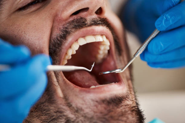 Best Emergency Dental Care for Broken or Chipped Teeth in Ville Ptte, LA