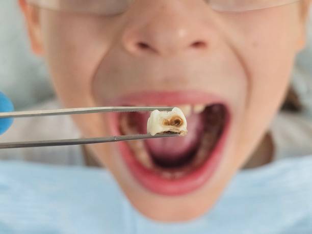 Best Urgent Care for Lost Fillings or Crowns in Ville Ptte, LA